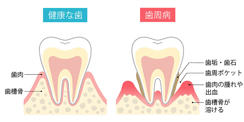 歯周病