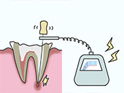 歯の神経の治療